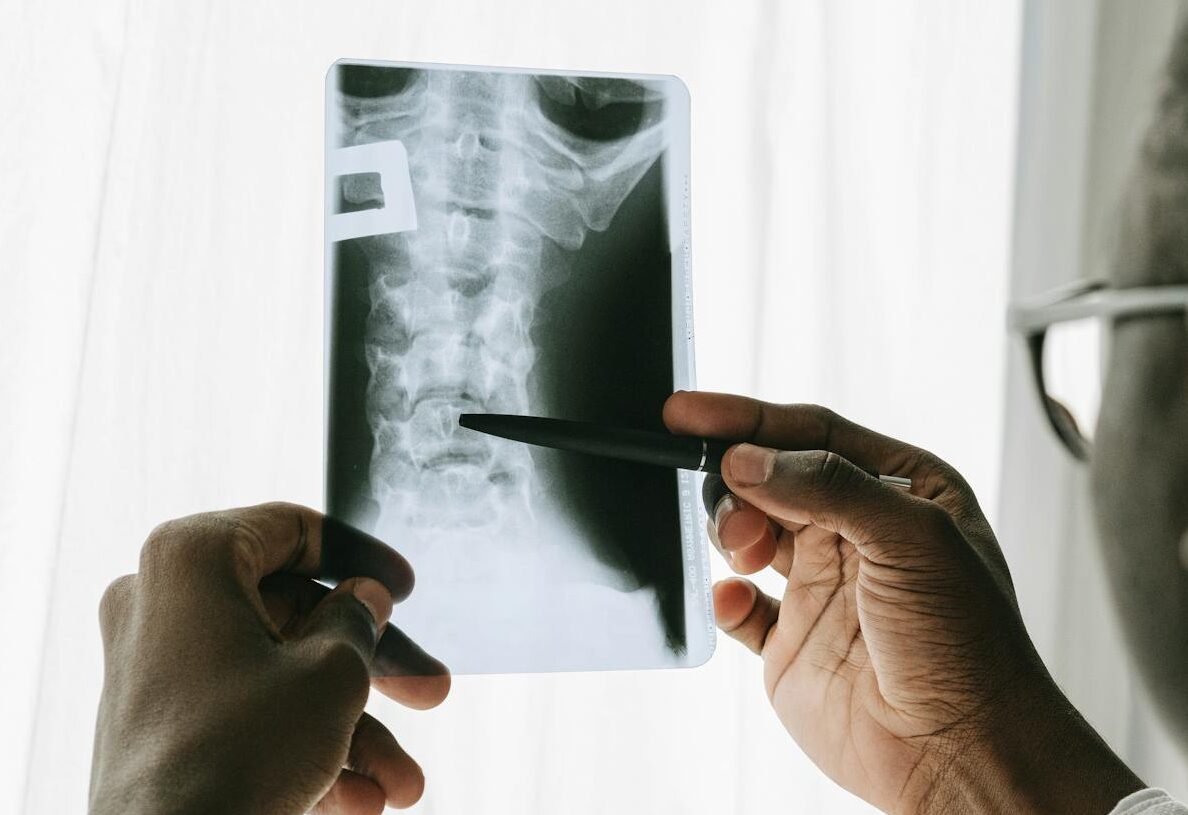 Spinal Disc Problems Rising Among Kashmiri Youth, Doctors Blame Sedentary Lifestyle